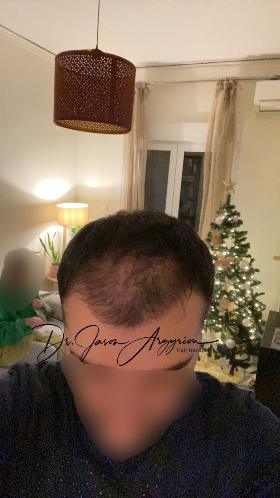 3months post-op.JPG