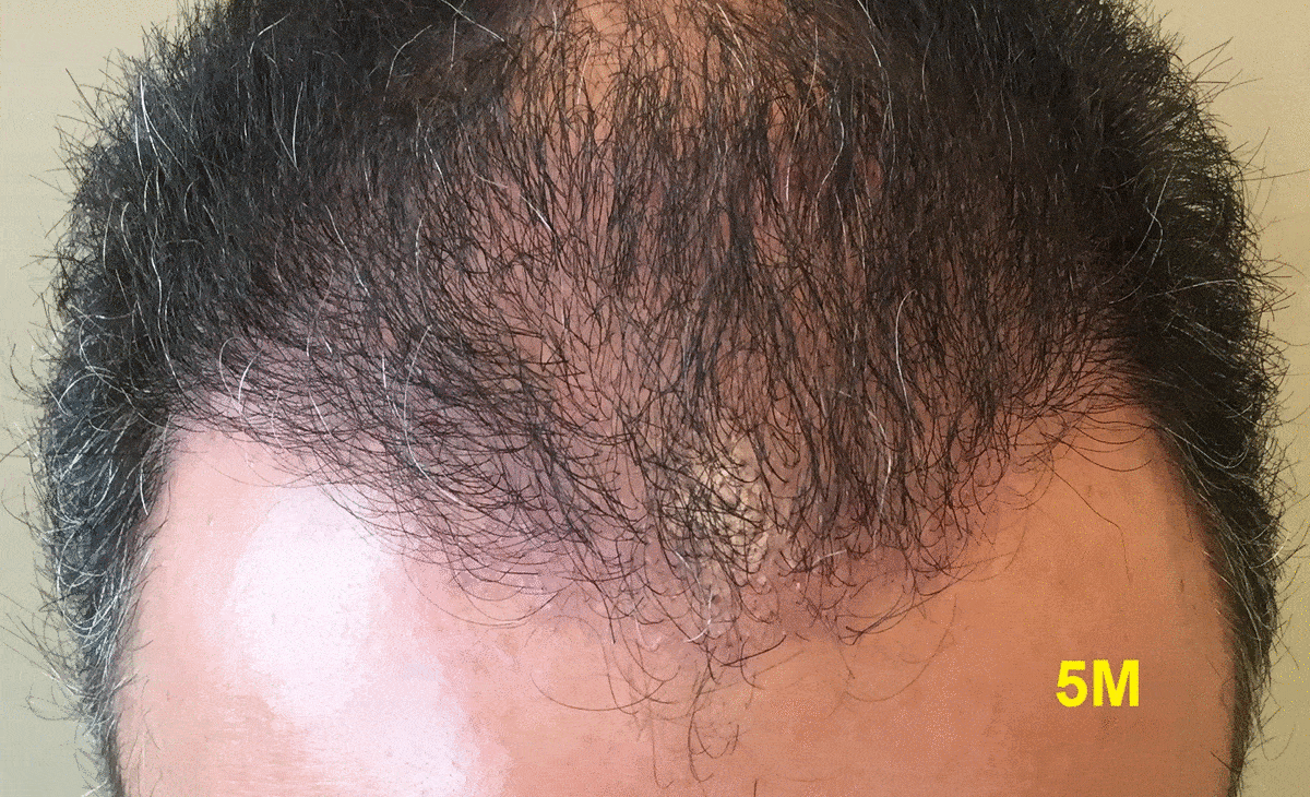5 ΤΟ 6 MONTHS REV.gif