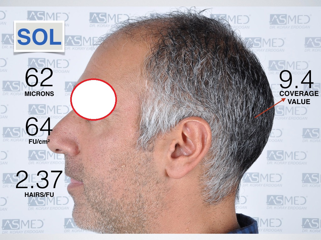 Analyze Left Parietal.jpeg