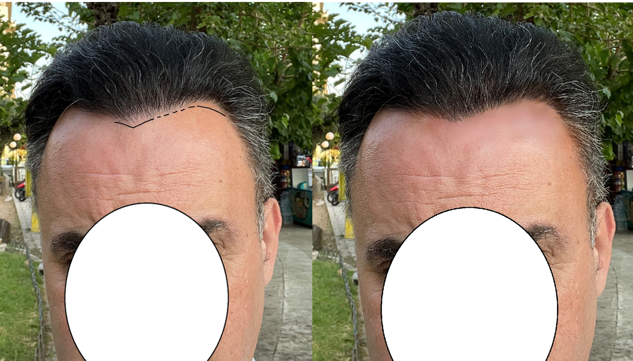 design hairline.png