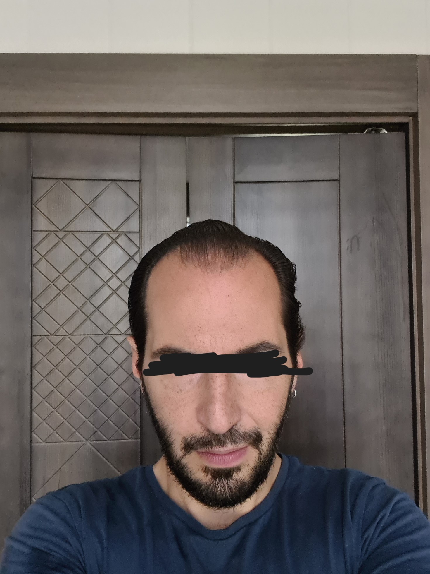 FrontalCombover.jpg