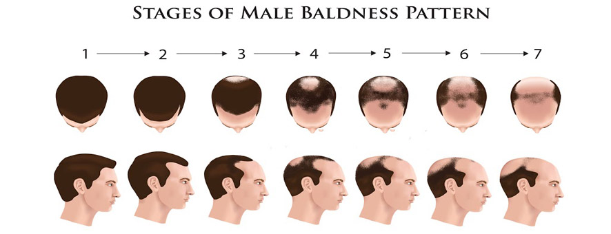 hair-loss-progress-men.jpg
