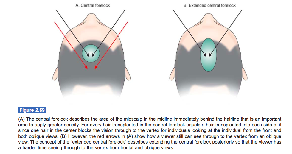 hair-transplant-central-forelock1.png