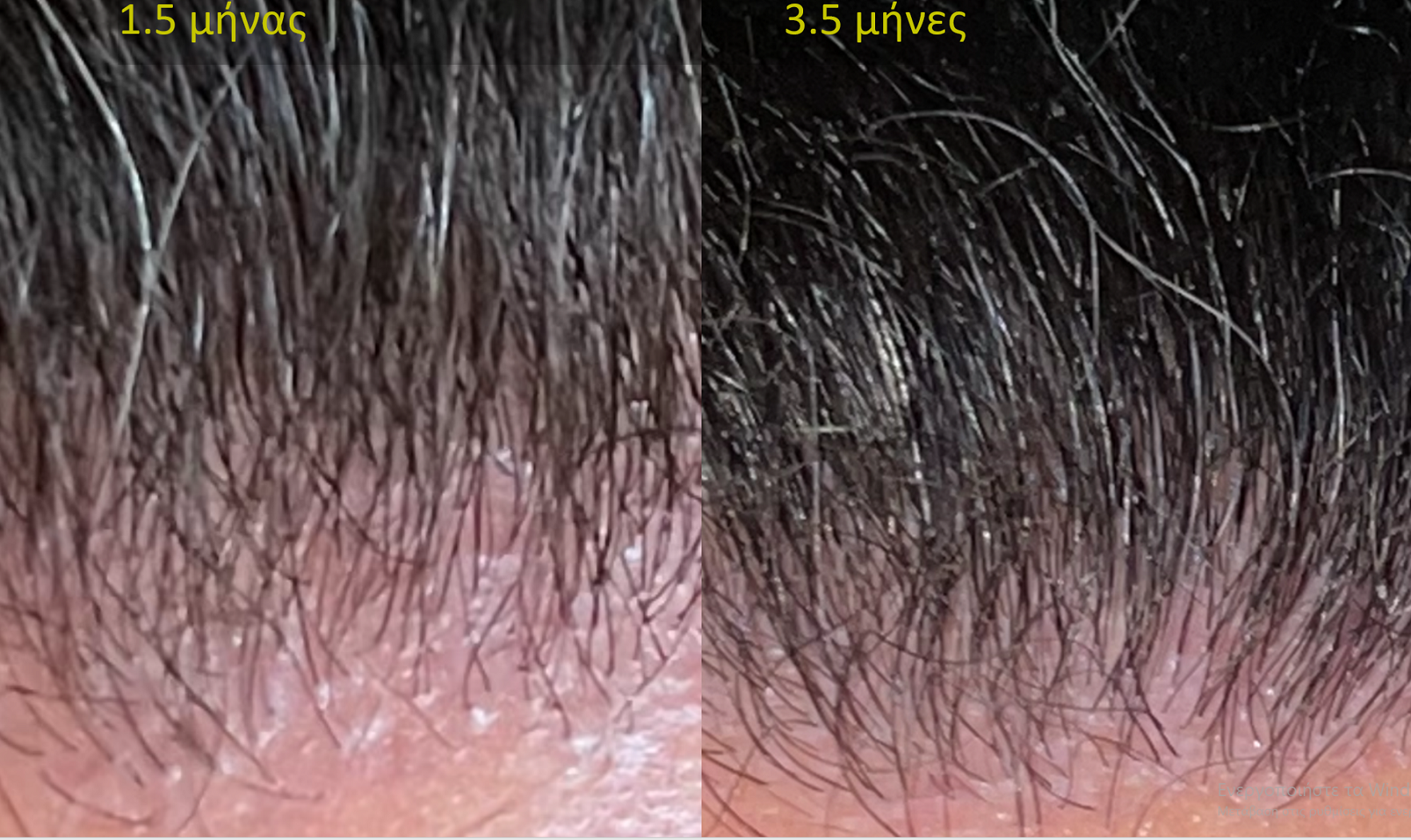 hairline 3,5.png
