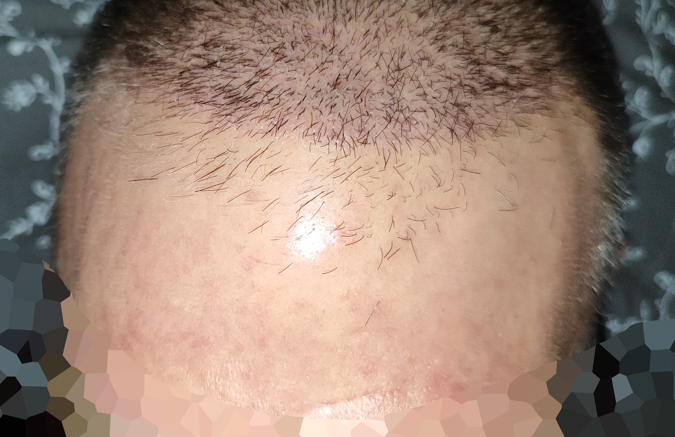 Hairline.jpg
