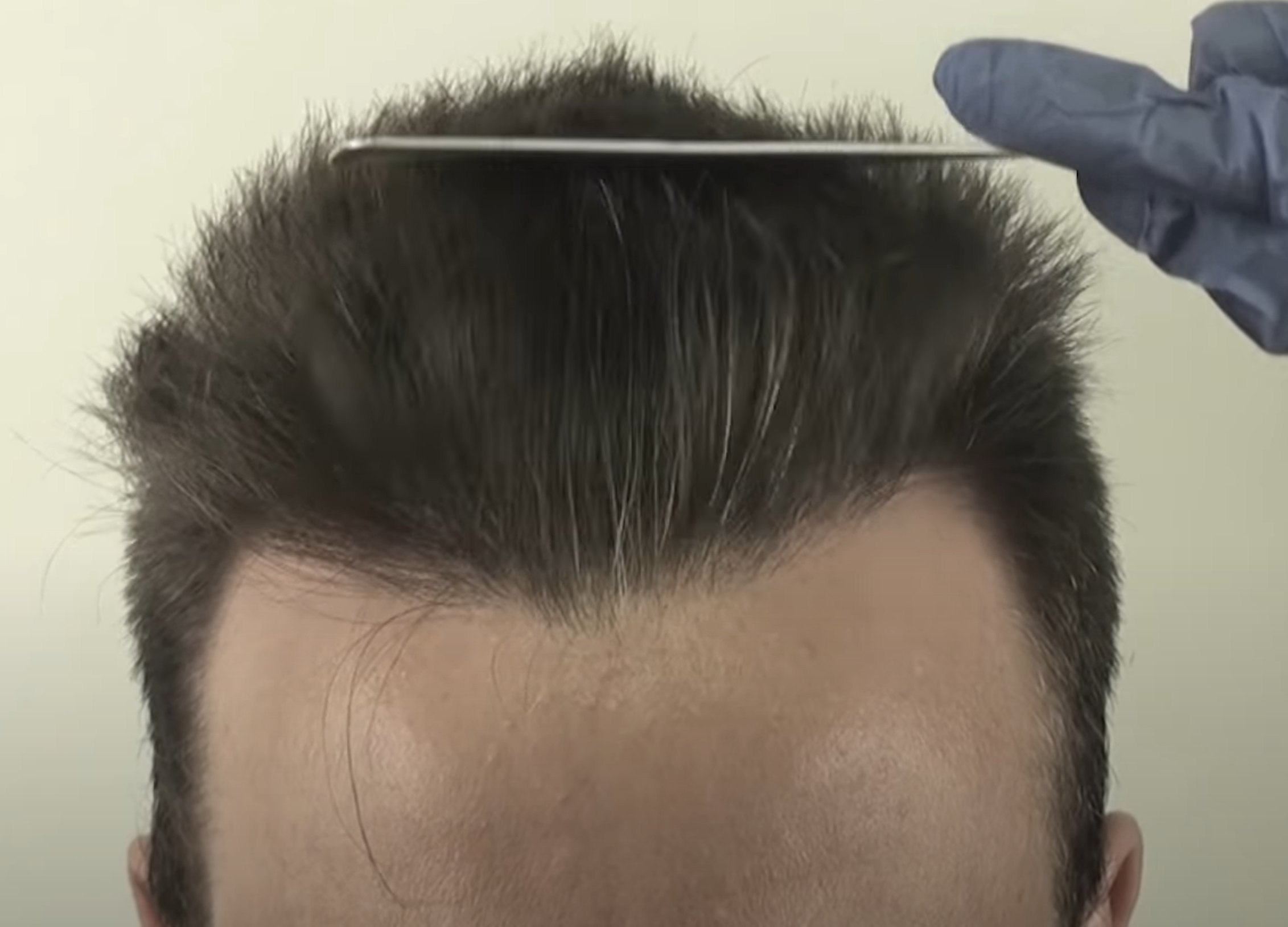 hairline.png