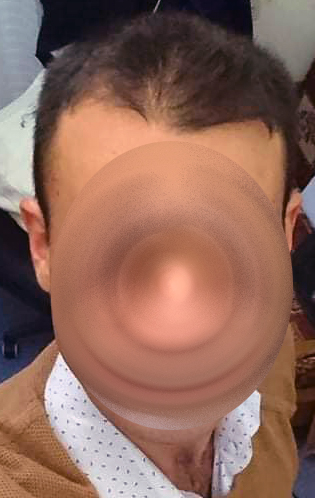 hairloss.jpg