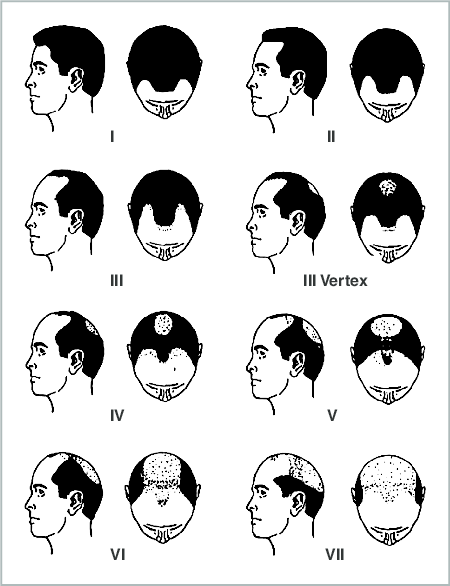 Pattern-of-androgenetic-alopecia-according-to-a-modified-Hamilton-Norwood-scale-used-by.png