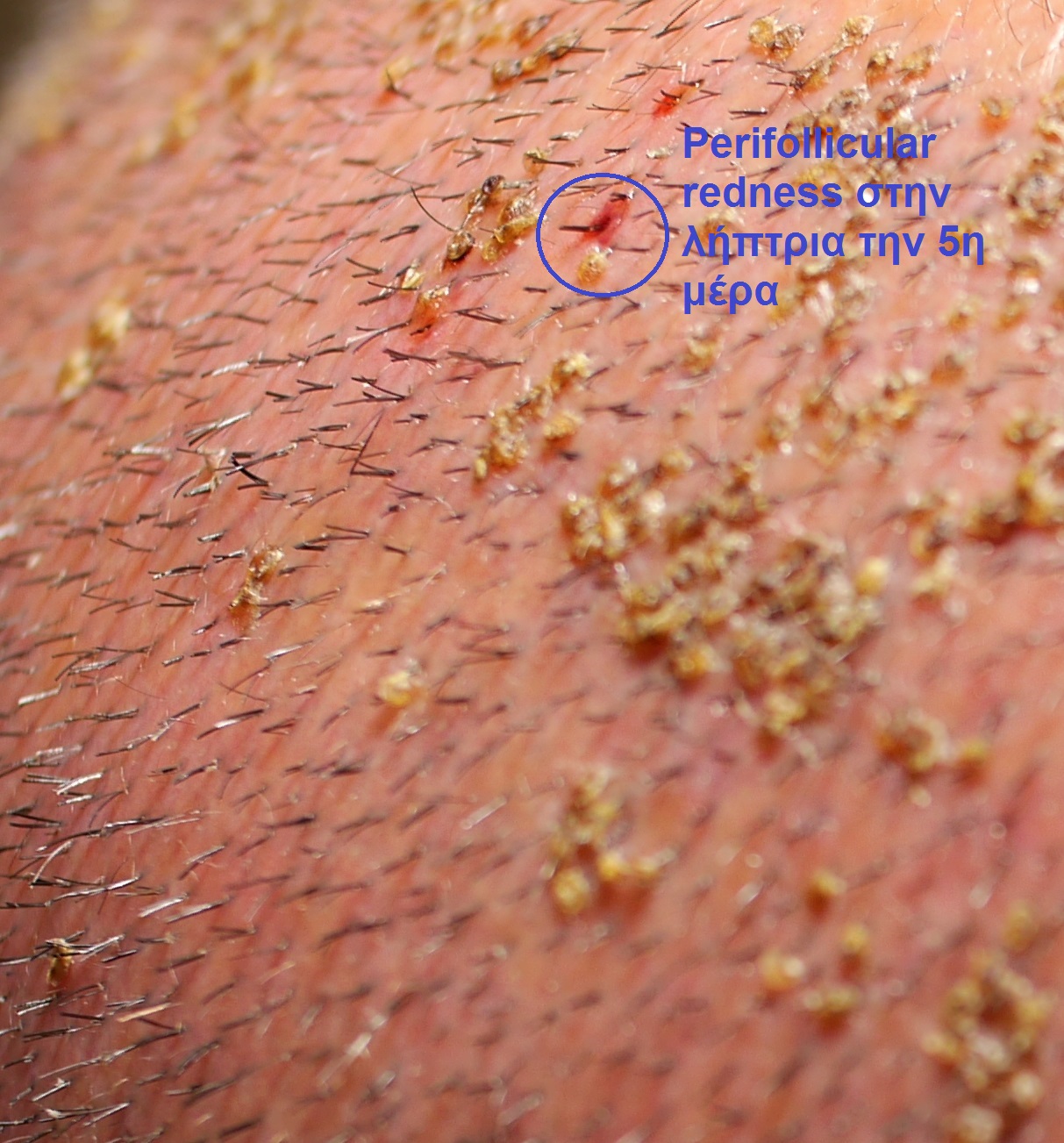 perifolicullar redness.jpg