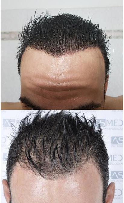 prin meta hairline.JPG