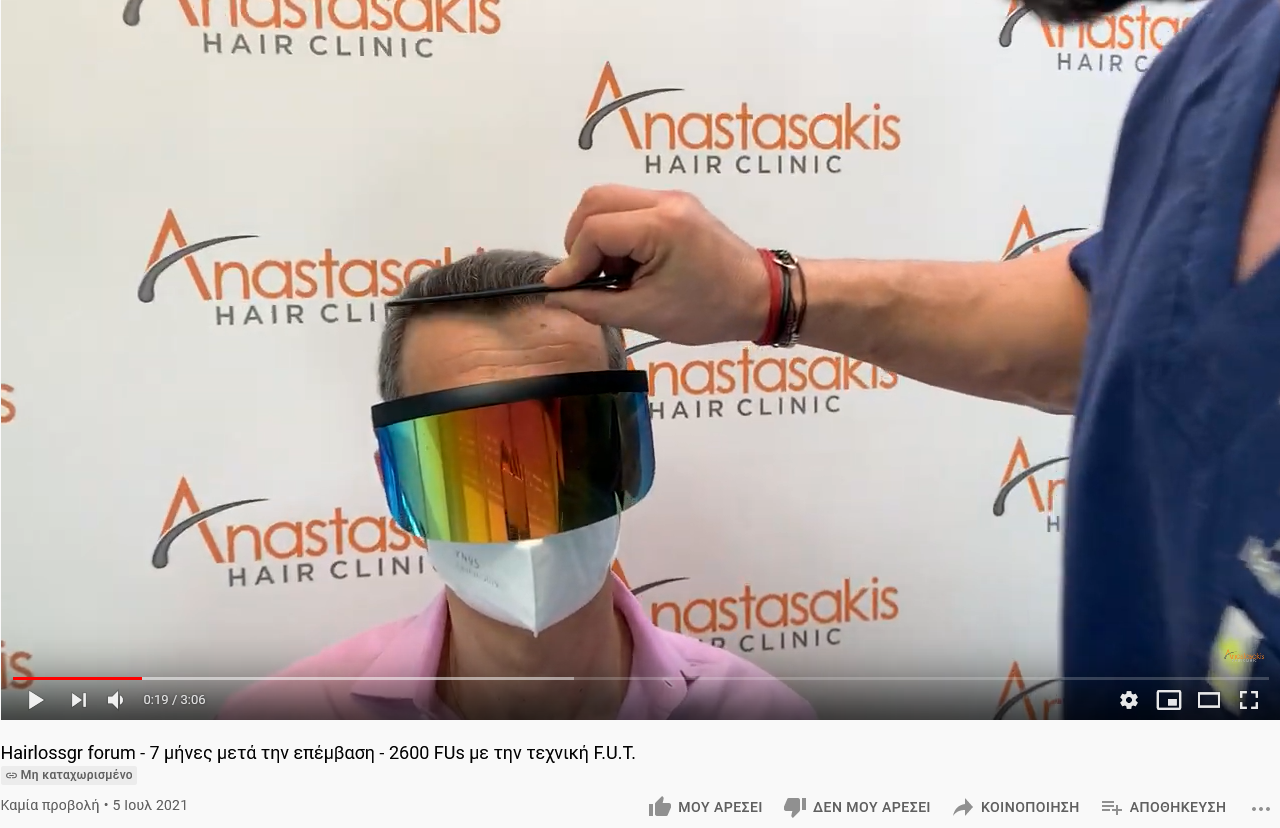 Screenshot 2021-07-05 at 17-05-25 Hairlossgr forum - 7 μήνες μετά την επέμβαση - 2600 FUs με τ...png