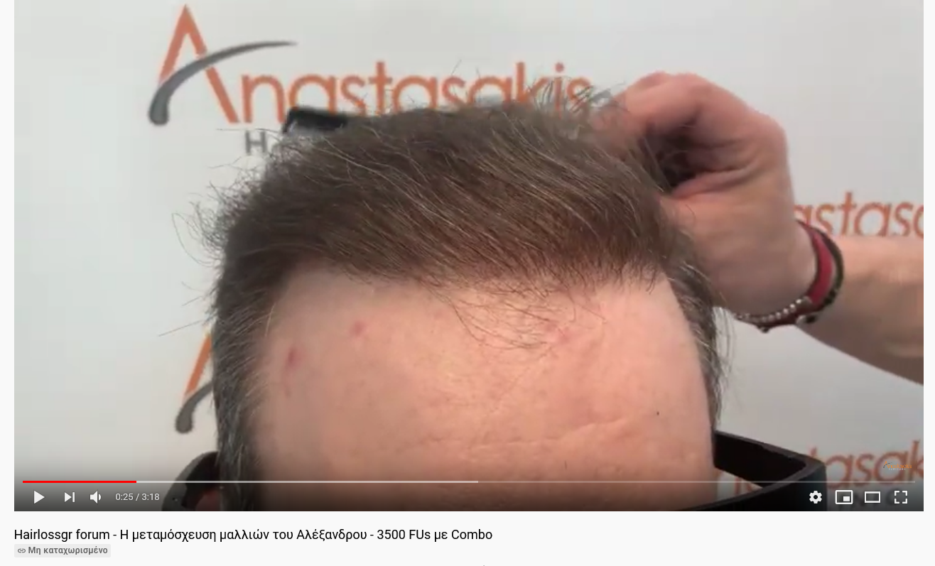 Screenshot 2021-07-30 at 14-52-50 Hairlossgr forum - Η μεταμόσχευση μαλλιών του Αλέξανδρου - 3...png