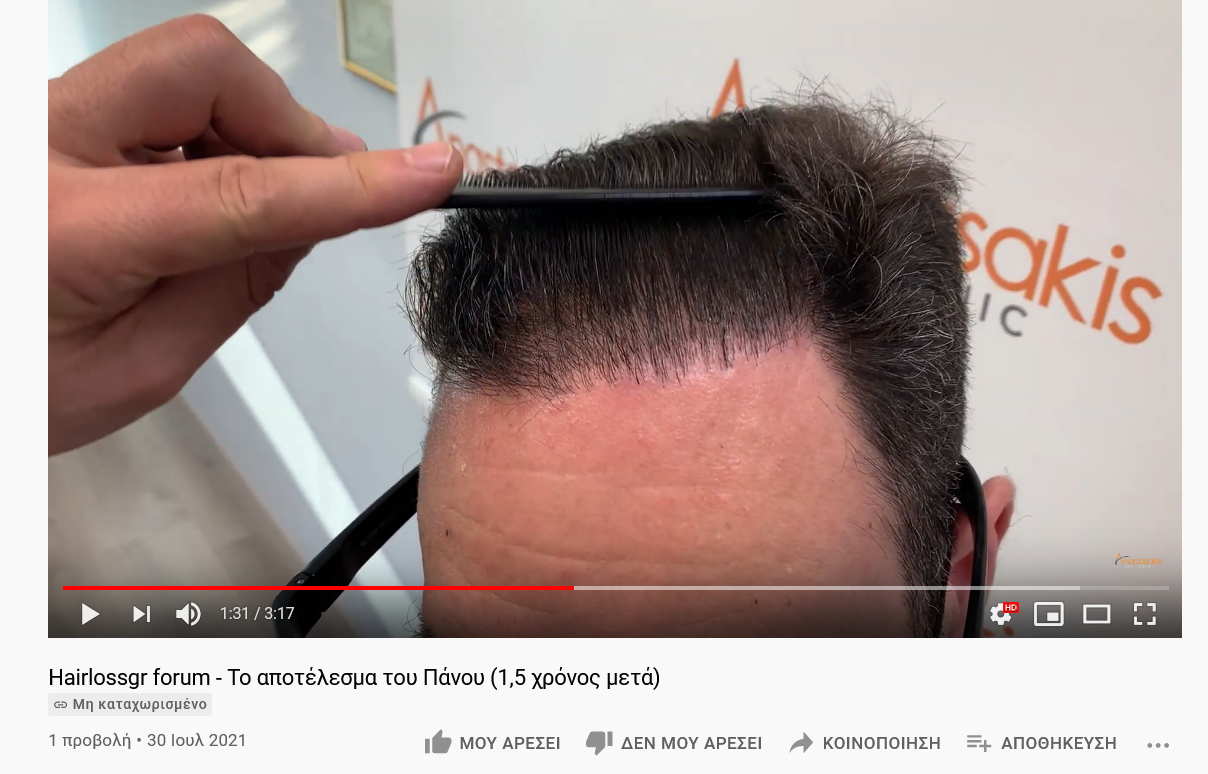 Screenshot 2021-07-31 at 10-54-12 Hairlossgr forum - Το αποτέλεσμα του Πάνου (1,5 χρόνος μετά).png