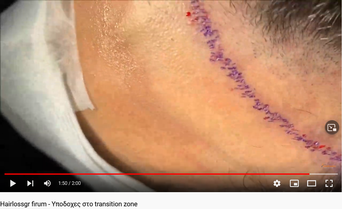 Screenshot 2021-10-16 at 12-59-40 Hairlossgr firum - Υποδοχες στο transition zone.png