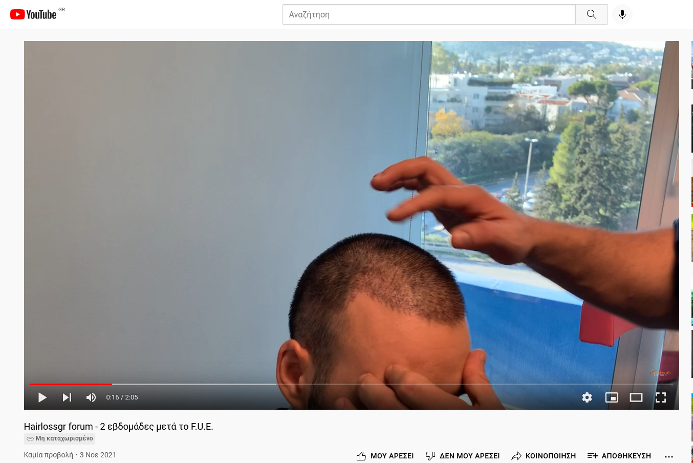 Screenshot 2021-11-03 at 17-01-23 Hairlossgr forum - 2 εβδομάδες μετά το F U E .png