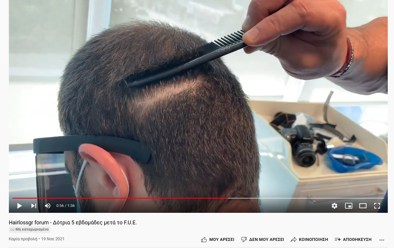 Screenshot 2021-11-19 at 18-18-45 Hairlossgr forum - Δότρια 5 εβδομάδες μετά το F U E .png