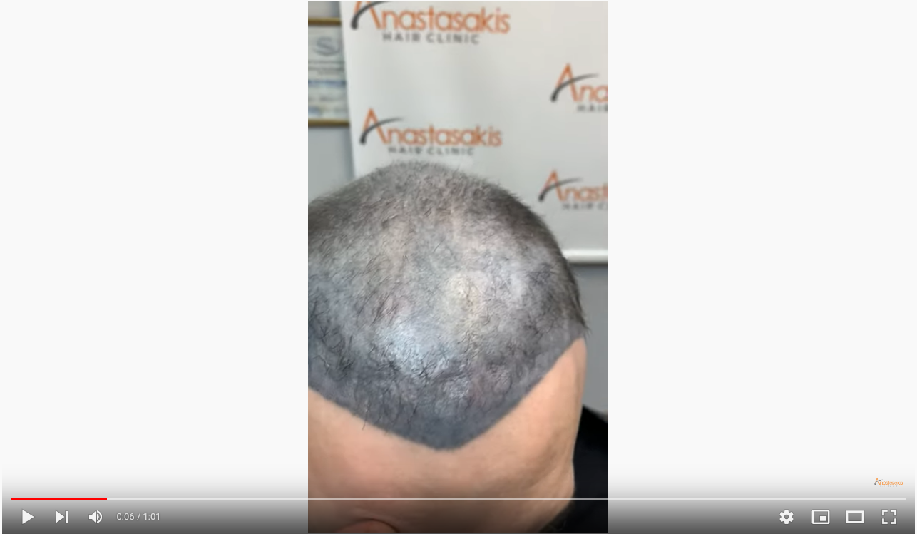 Screenshot 2021-11-26 at 17-17-40 Hairlossgr forum - Tattoo.png