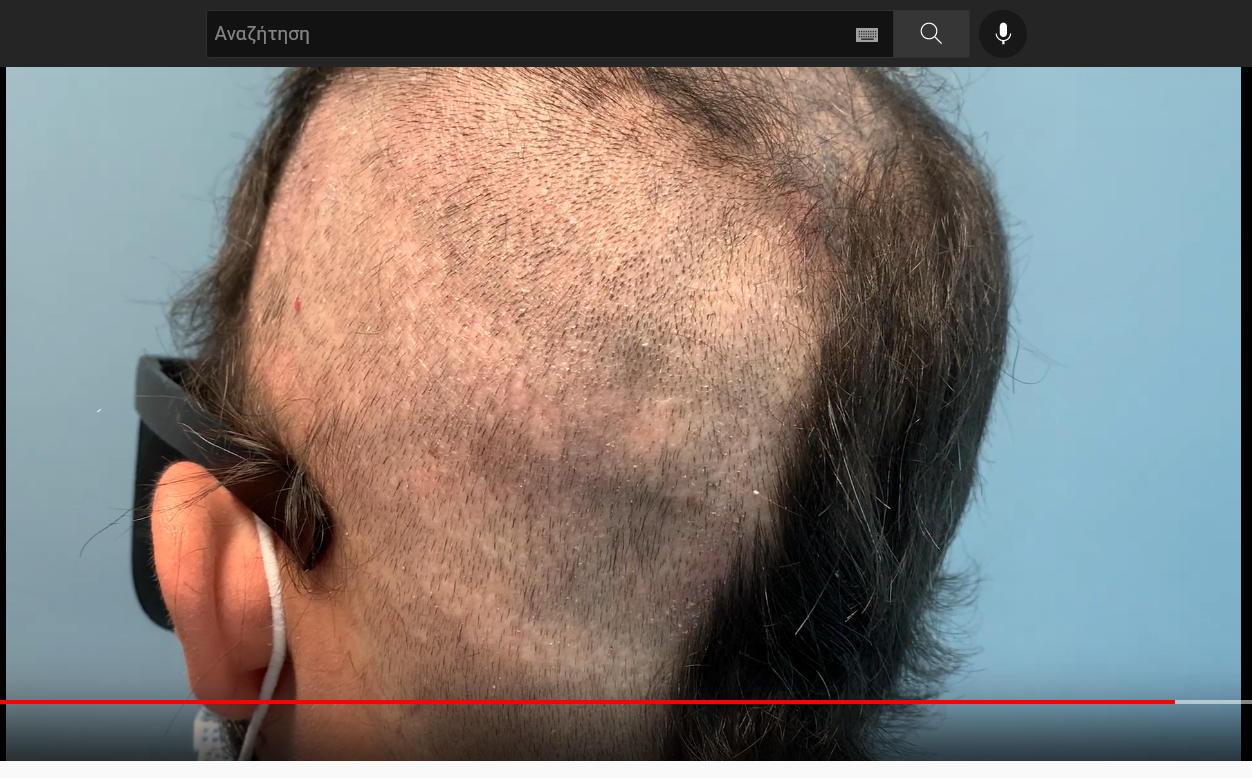 Screenshot 2021-12-26 at 13-02-19 Hairlossgr forum - Δότρια από προηγούμενη Μεταμόσχευση μαλλιών.png