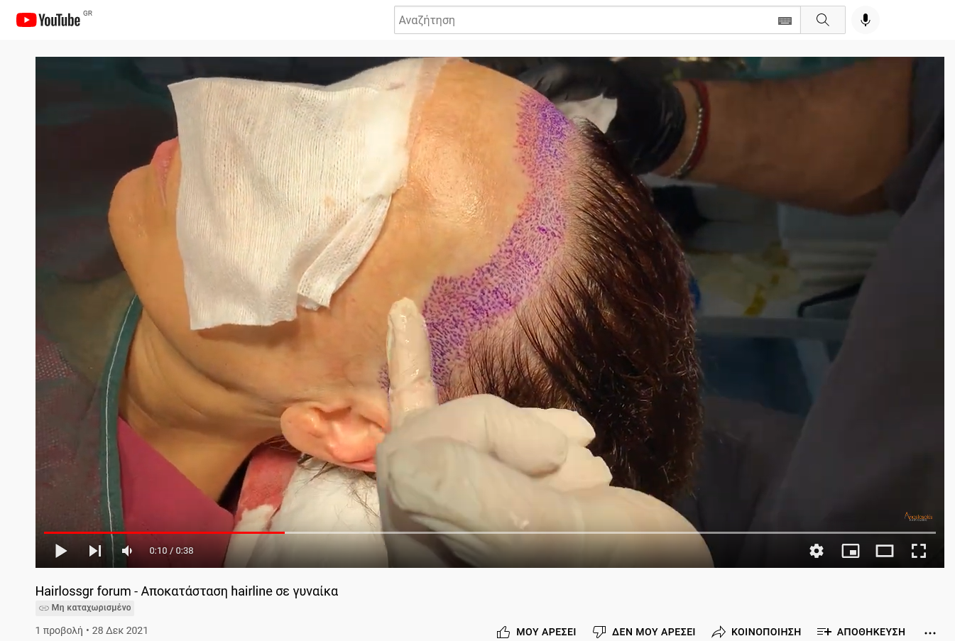 Screenshot 2021-12-28 at 17-42-19 Hairlossgr forum - Αποκατάσταση hairline σε γυναίκα.png