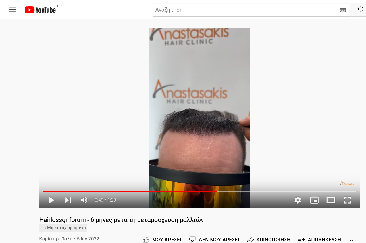 Screenshot 2022-01-06 at 20-55-03 Hairlossgr forum - 6 μήνες μετά τη μεταμόσχευση μαλλιών.png