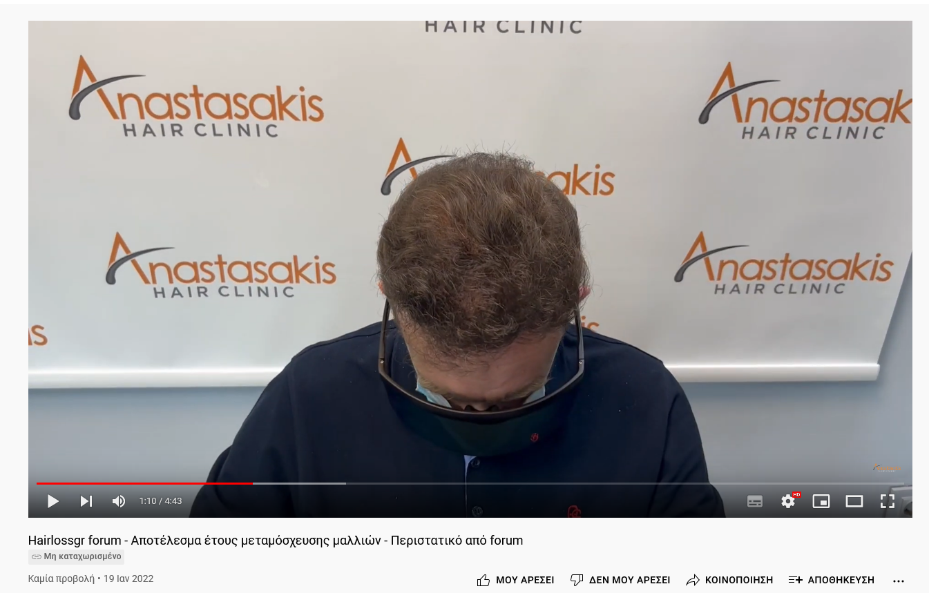 Screenshot 2022-01-19 at 17-10-22 Hairlossgr forum - Αποτέλεσμα έτους μεταμόσχευσης μαλλιών - ...png