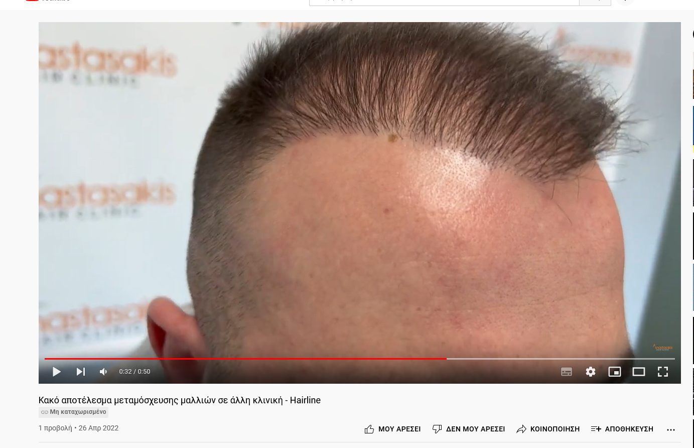 Screenshot 2022-04-27 at 17-48-04 Κακό αποτέλεσμα μεταμόσχευσης μαλλιών σε άλλη κλινική - Hair...png