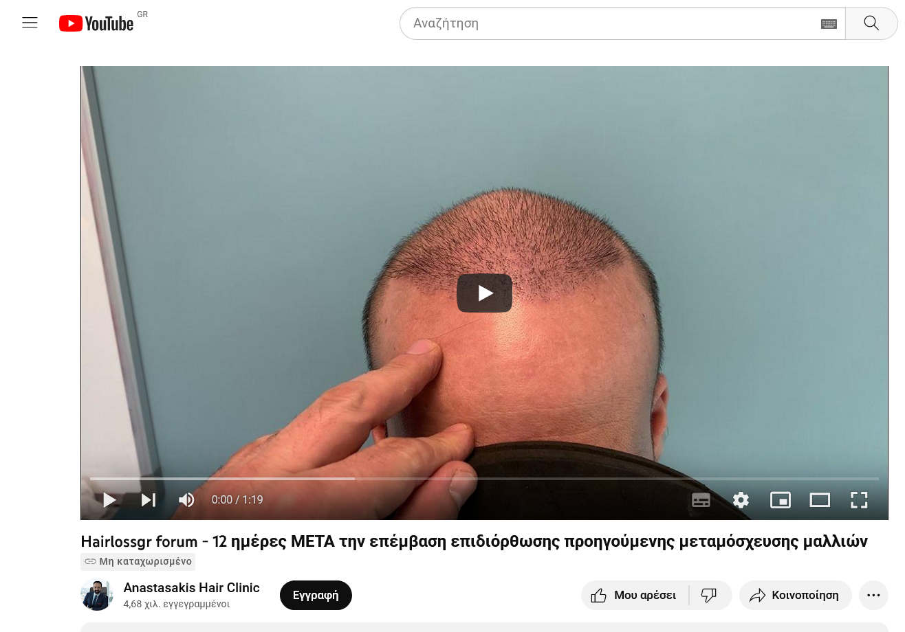 Screenshot 2022-11-27 at 15-42-39 Hairlossgr forum - 12 ημέρες ΜΕΤΑ την επέμβαση επιδιόρθωσης ...png