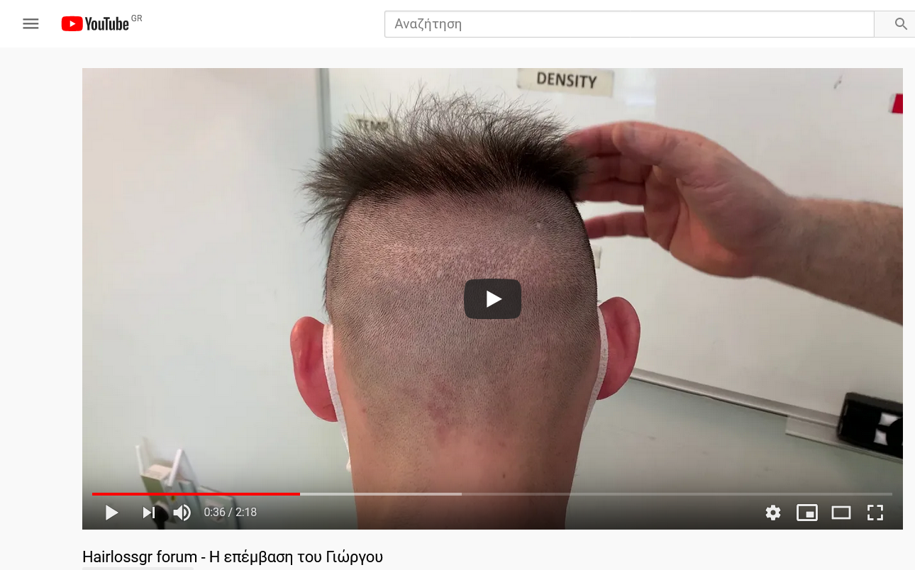 Screenshot_2021-04-26 Hairlossgr forum - Η επέμβαση του Γιώργου.png