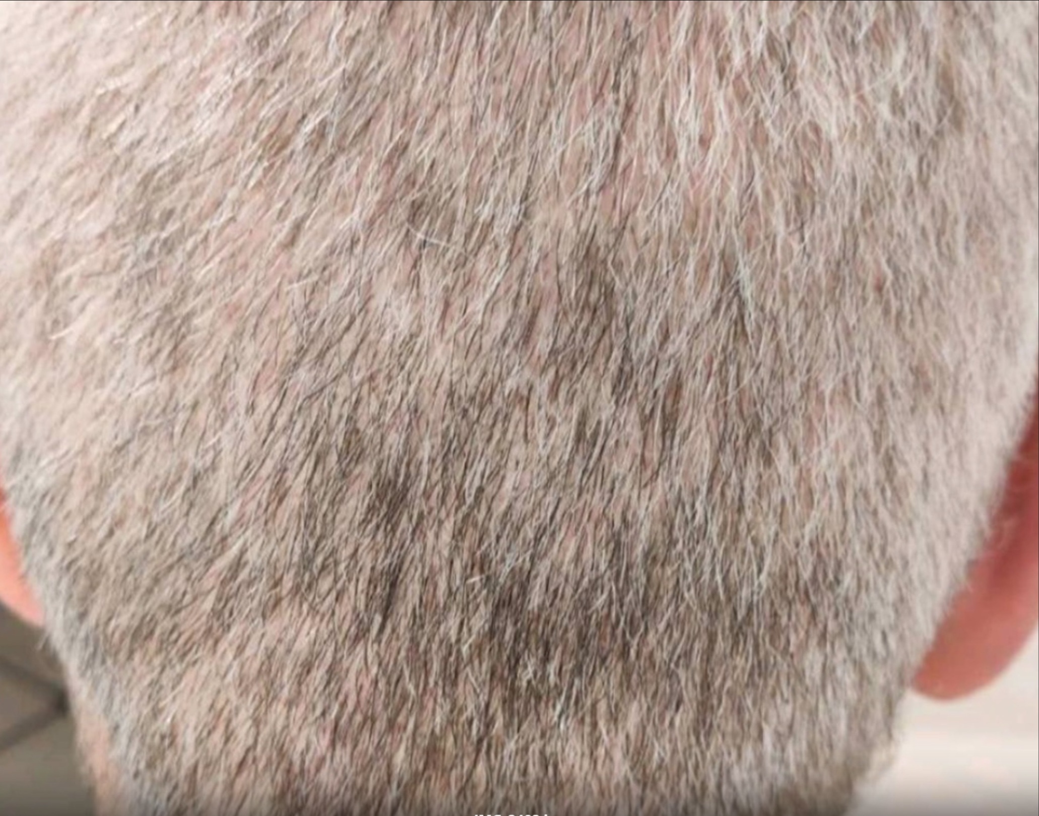 sunbald 3 months pure.jpg