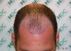 post op 3100 Strip grafts.jpg