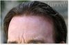Hair-Loss-Dublin.jpg