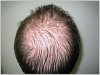 Hair-Loss-Baldness.jpg