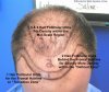 frontal-hairline-hair-transplants.jpg