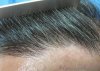 hair-transplant-hairline-closeup-156802.jpg