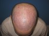 2010_ 800 chest grafts.jpg