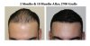 2700 grafts- 2 months and 10 months after.jpg