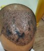 Necrosis-hair-transplant.jpg