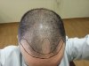 hairline 1500 Grafts.jpg
