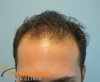 front-hairline-before.JPG