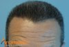 hairline-after.jpg