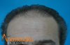 hairline-before.jpg