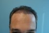 hairline-after7days.JPG