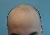 hairline-before.JPG