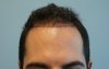 hairline2-before.jpg