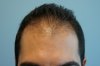 hairline-before.jpg