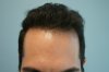 hairline-after.jpg