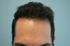 hairline-after.jpg