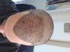 scalp_day_7.jpg