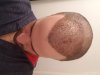 scalp_day_10.jpg