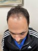 1. Before FUE 2660 grafts.jpg